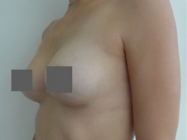 bruststraffung-stuttgart-mit-implantat
